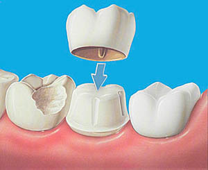 протезирование зубов в Рязани