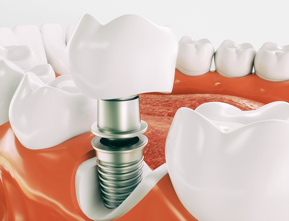 Имплантация зубов в Рязани