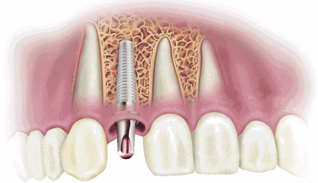 протезирование зубов в Рязани