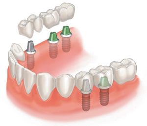 протезирование зубов в нашей стоматологии