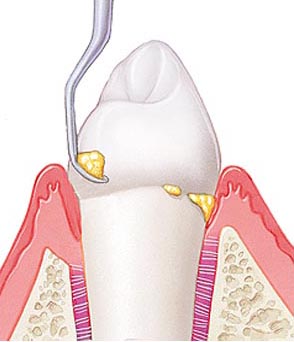 зубной камень, стоматология рязань